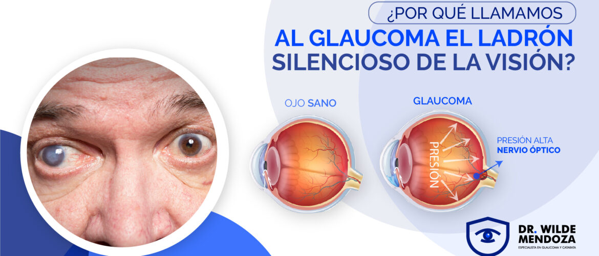 Glaucoma: El “Ladrón Silencioso de la Visión”